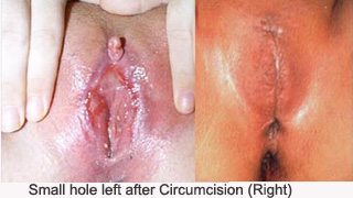 suturing in female genital mutilations