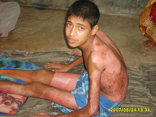 Samrat mandal burned alive in West Bengal, India
