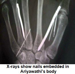 x-ray-reveals-nails-in-Ariyawathi-body inserted by Saudi employer